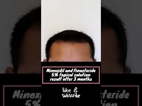 Try - INSANE Minoxidil Result after 3 months! #minoxidil #hairregrowth  #haircare #minoxidilresult