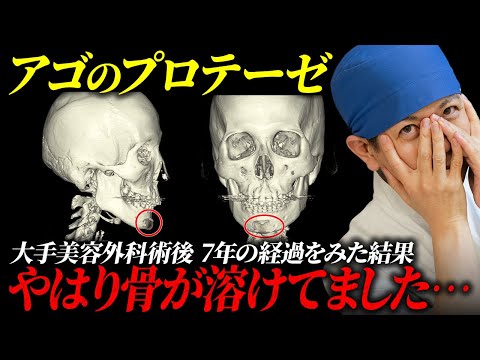 【3DCTで発覚】大手美容外科“TOPドクター”のアゴ、鼻プロテーゼが曲がってる！骨も溶けてる！！美容外科歴20年の専門家が詳しく解説します。