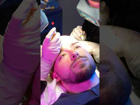 Cosmedica Clinic Hair Transplant in Turkey #shorts #hairtransplant #video