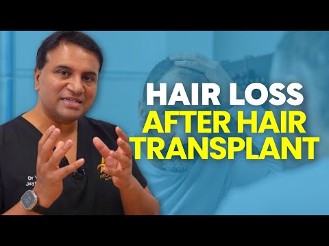 Shock Loss After a Hair Transplant?