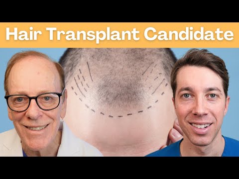 How to Pick the Perfect Candidate for a Hair Transplant