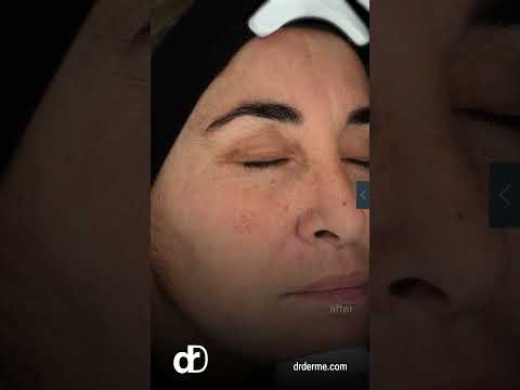 ✨ Fade Pigmentation Fast | Real Before & After ✨