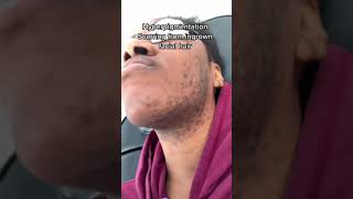 Doctor does Laser hair removal for facial hair, hyperpigmentation and scarring. Dark skin tone!!!