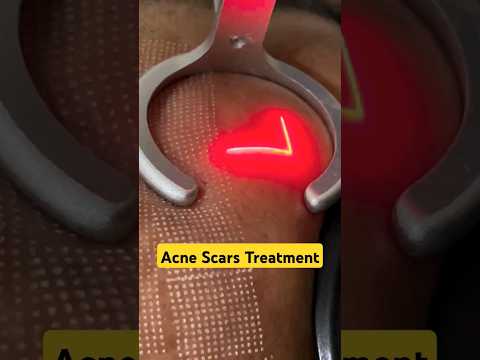 Laser Treatments for Acne Scars | Acne Scar Treatments #fractional #laser #prpforface #shorts