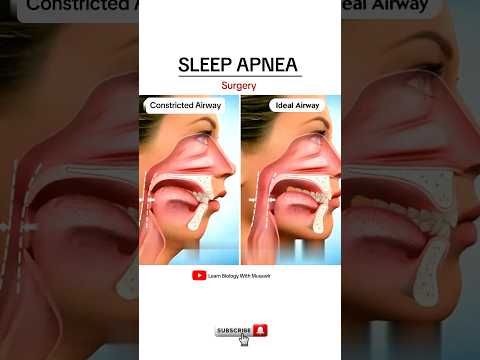 Sleep apnea surgery - Animated Video