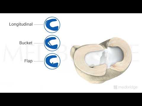 Meniscus Tear - Patient Education | Medbridge