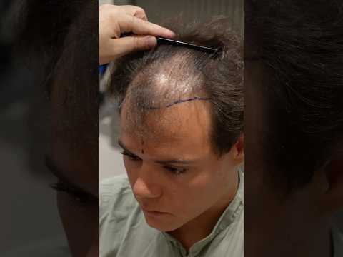 Cosmedica Clinic Hair Transplant in Turkey #shorts #hairtransplant #video