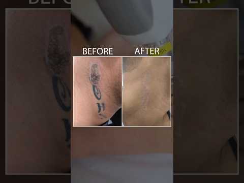 Laser Tattoo Removal Treatment at Skinaa Clinic #Viral #viralshorts