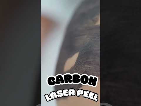 Carbon Laser Peel I Hollywood Peel I Carbon Laser Treatment #beautytreatment #skincare