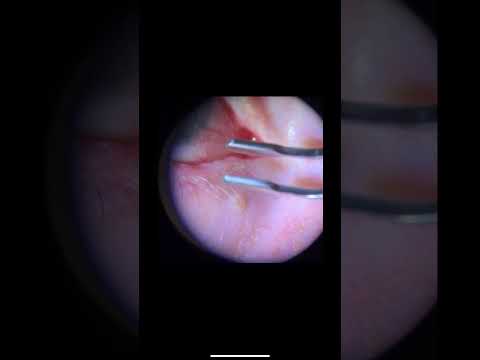 Meibomian gland extraction