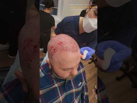 💪🏻Immediate Impact of Hair Transplant Procedure / #hairregrowth #fuehairtransplants