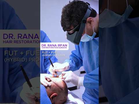 𝗦𝘂𝗿𝗴𝗲𝗿𝘆 𝗗𝗮𝘆 FUT + FUE (Hybrid) Procedure ! #drranairfan  #baldness #hairtransplant #fyp #shorts