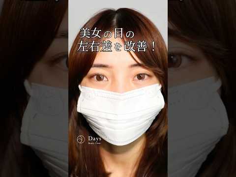 [Double eyelid surgery] I want to improve the complicated difference between the left and right e...