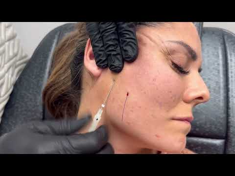 Thread Lift with Dr.Gideon Kwok│Skin Perfect Medical