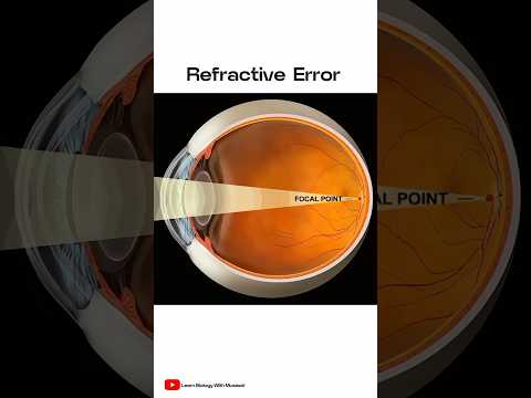 What is Refractive Error 👀 ? #shorts