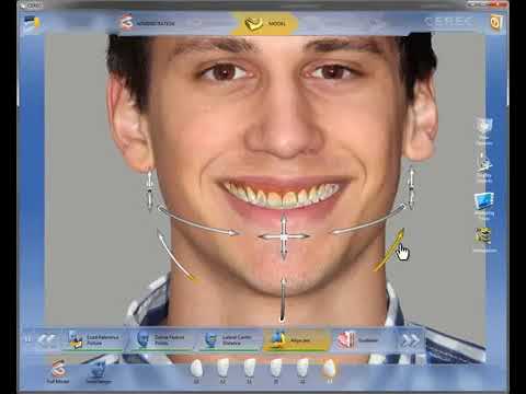 高雄CEREC 3D全瓷齒雕機操作介紹【品適牙醫】高雄3D全瓷牙 沈坤男院長推薦