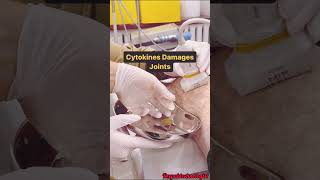 Cytokinase demage joints#trending#feedshorts#ytshorts#vireo#virelshorts#medellin#jointpain#hospital