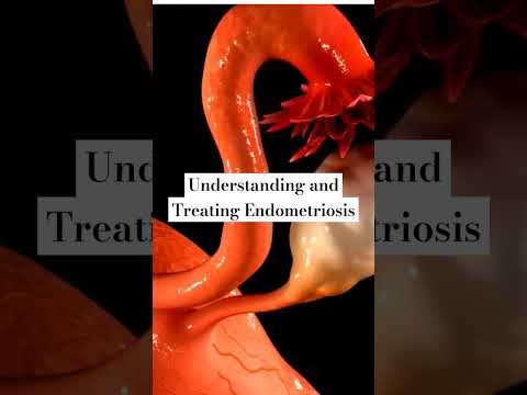 Understanding and Treating Endometriosis #endometriosis #painfulperiod#infertility #irregularperiod