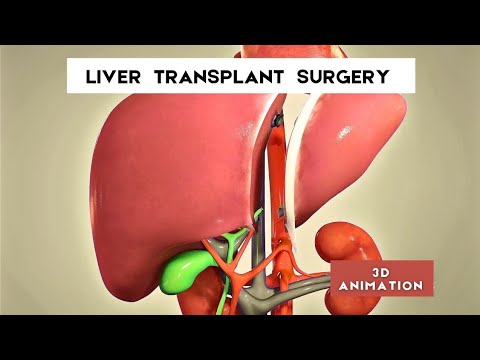 liver transplant surgery procedure - 3D Animation