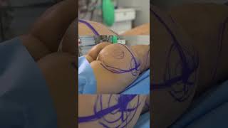 BBL: Shape and Projection 🍑