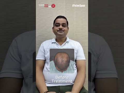 Hair Loss Treatment That Works: Santosh’s Amazing Results! | Testimonial | HairMD Clinic, pune