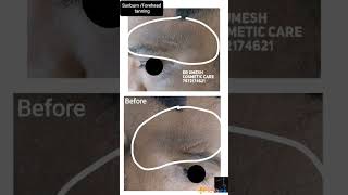 #detanfacial #cosmetic #face #skincare #skin #skinlove #medifacial #skinwhitening #skinglow sking