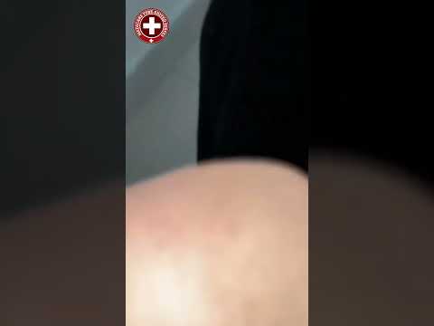 Tooth gingival recession #dentist #shorts  #trending #youtubeshorts #shortvideo