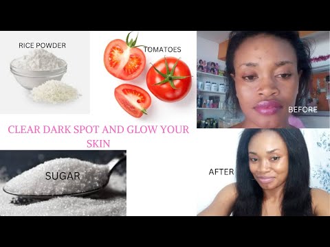 HOW TO GET RID OF DARK SPOTS ON FACE AND FACE // CLEAR ACNE SCARS IN  7 DAYS