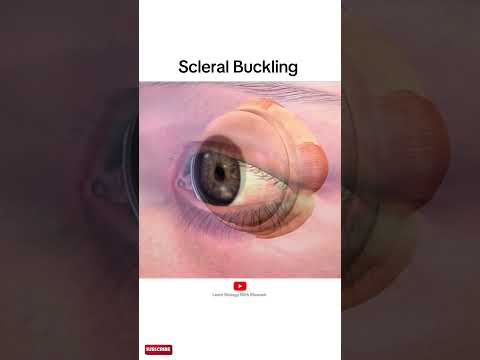 Scleral buckling | animation video