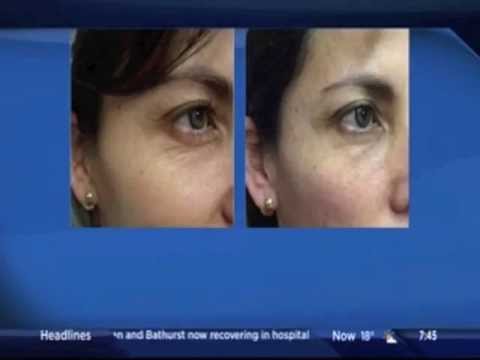 Dr. Carroll Demystifies The Vampire Facial