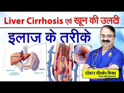 Liver Cirrhosis एव खून की उल्टी इलाज के तरीके || HOW IS CIRRHOSIS CAUSED BLEEDING TREATED