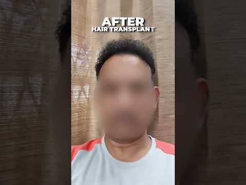 Hair Transplant Results of a Patient at Skinaa Clinic Jaipur  #Viral #skinaaclinic #shortsviral