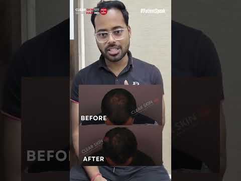 Crown Hair Loss: Amazing Results in Just 3 Months! | HairMd Clinic, Pune