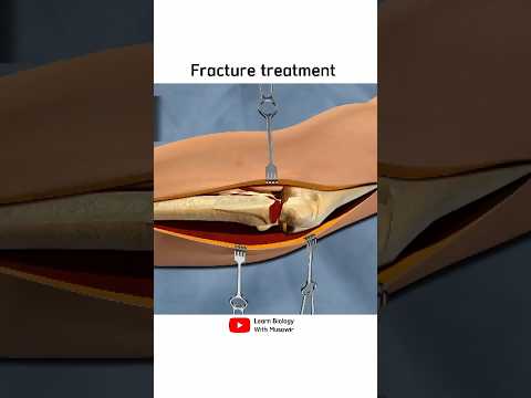 Hand bone fracture treatment | 3D animation