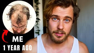 Preventing Balding: What I Did Before It Was Too Late.