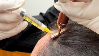 PRP Injections for Hair Loss #prp #prpinjection #hairlosstreatment