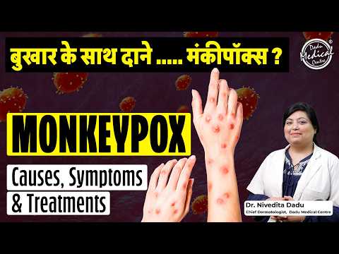 MONKEYPOX क्या है और कैसे फैलता है? | Causes, Symptoms & Treatment | MPOX Virus in India