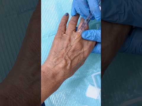 Hand rejuvenation with Filler injection! Wait to see the before and after ! 💉🤩