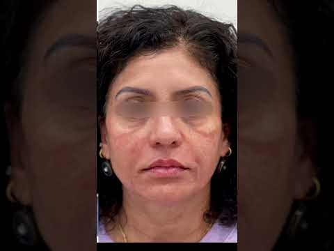 phase 1! Improve lift with filler, dissolve bad undereye filler, improve skin #torontolife #filler