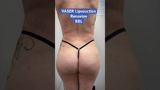 360 VASER Lipo + Renuvion + BBL = Hourglass 🔥 - Dr. Amir Arsalan | West End Plastic Surgery