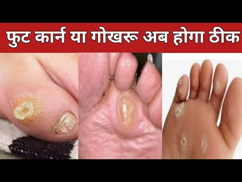 foot corn क्यों हो जाते हैं l फुट कार्न कैसे ठीक होगा gokhru kaise sahi hota hai l foot corn ka ilaj