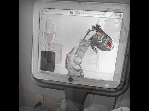 3D-ITero Scanning!
