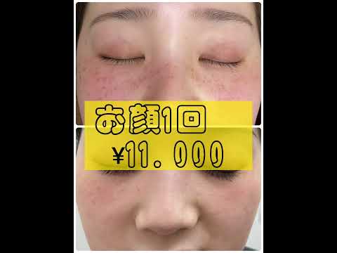 #湘南美容クリニック　#湘南美容クリニック札幌　#ピコレーザー　#シミ　#シミ取り