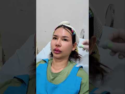 ลาที ปากมาสด้า #แม่โบว์คุณแม่ลูกสาม #ปากมาสด้า #ฉีดปาก #หมอเติ้ง #ออโรร่าคลีนิค