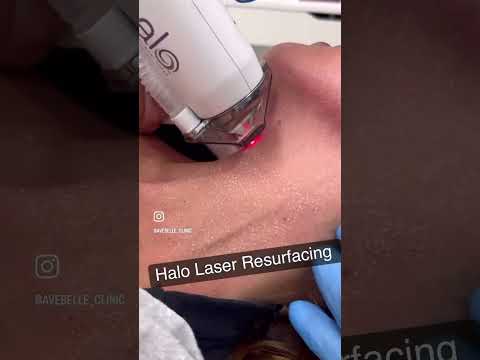 Halo laser resurfacing! Golden treatment for all skin concerns! ⚡️⚡️⚡️
