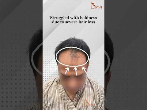 Long Hair Transplant in Delhi | Divine Aesthetic Hair Transplant Result