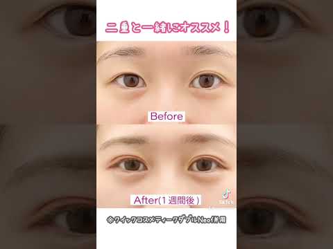 💖涙袋ヒアルロン酸💖Before After…これで愛され顔へ！#ヒアルロン酸#ヒアルロン酸注入#ヒアルロン酸注射#涙袋#湘南美容クリニック#湘南美容クリニック札幌院