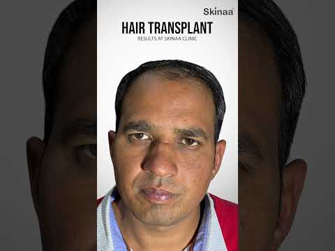 Skinaa clinic now for hair transplant  | Hair and confidence.