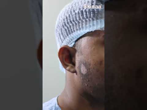 Punch Grafting Surgery for Vitiligo at Skinaa Clinic #short #viral