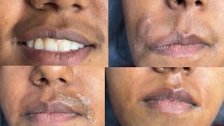 First time upper lips waxing by Gel wax/ Upper lips waxing tutorial/ #skincare #beauty #upperlipswax
